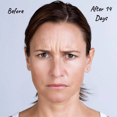 Xeomin Before and After Xeomin Before and After